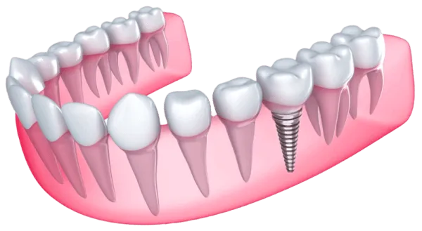 Permanent Zirconia Teeth Double Arch